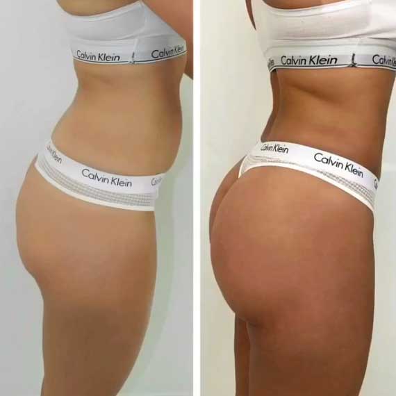 GluteUp Hip Trainer: il segreto smart per glutei sodi, pelle liscia e curve definite